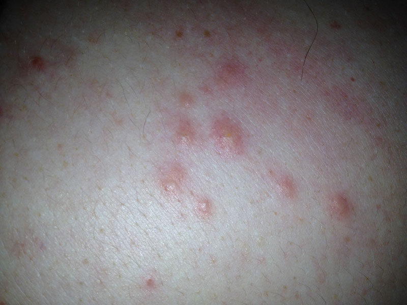 bouton après rasage pubien